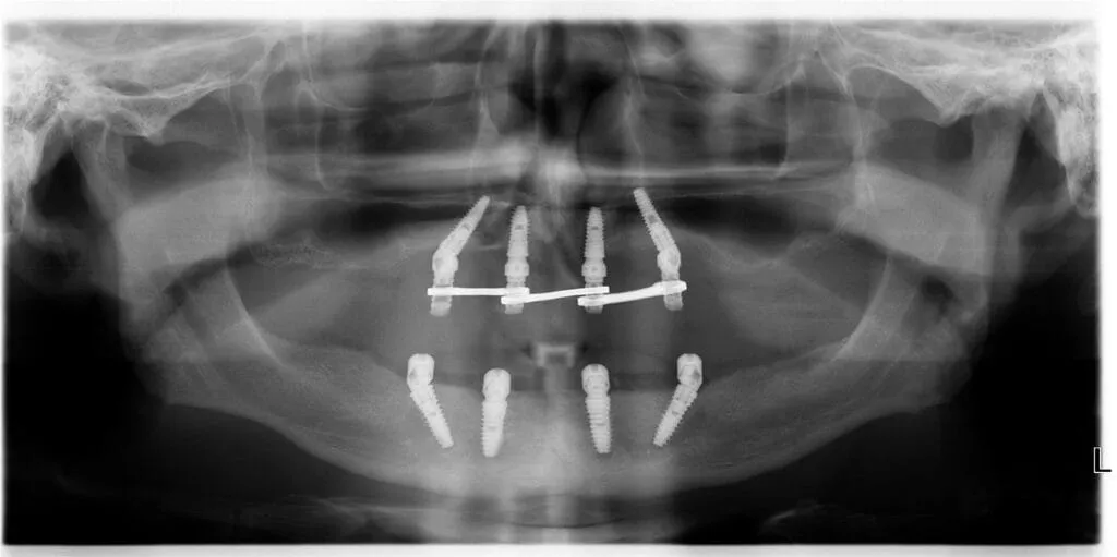 Visi dantys ant 4 implantų (VZ/AZ) — rentgeno nuotrauka