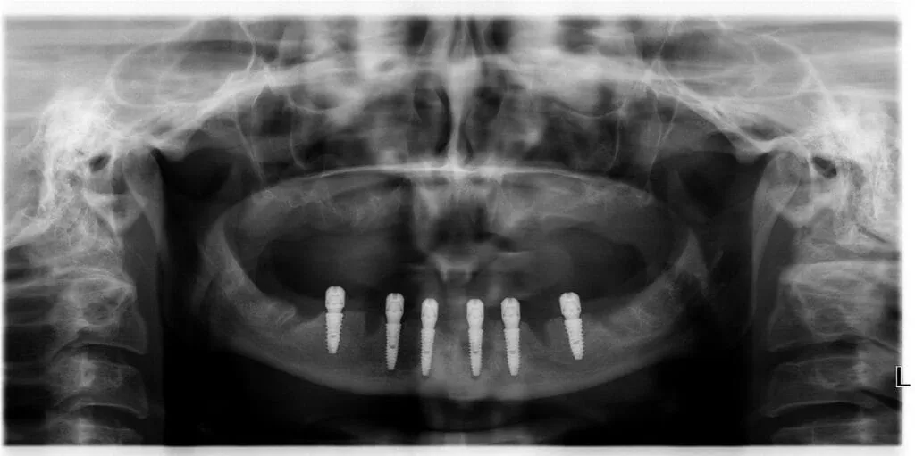 Visi dantys ant 6 implantų — rentgeno nuotrauka