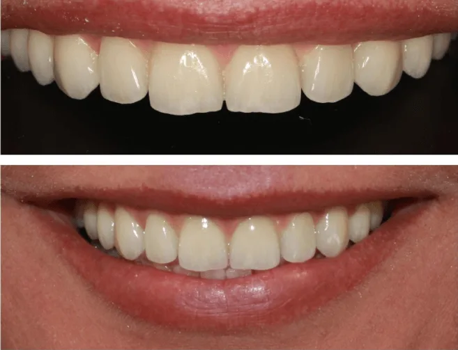 Visi dantys ant 4 implantu restauracija Visi dantys ant 4 implantu atstatymas 1